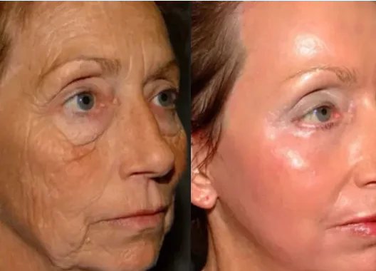 nanolaser_-e1689657376591 Nano-laser-treatment
