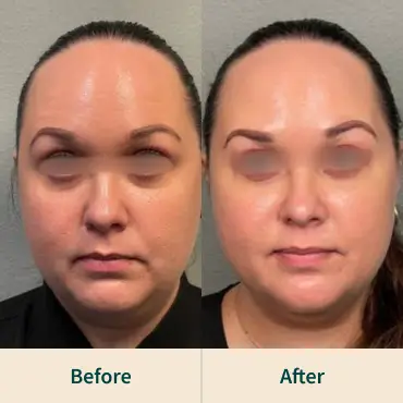 Dysport After-before Dysport After-before