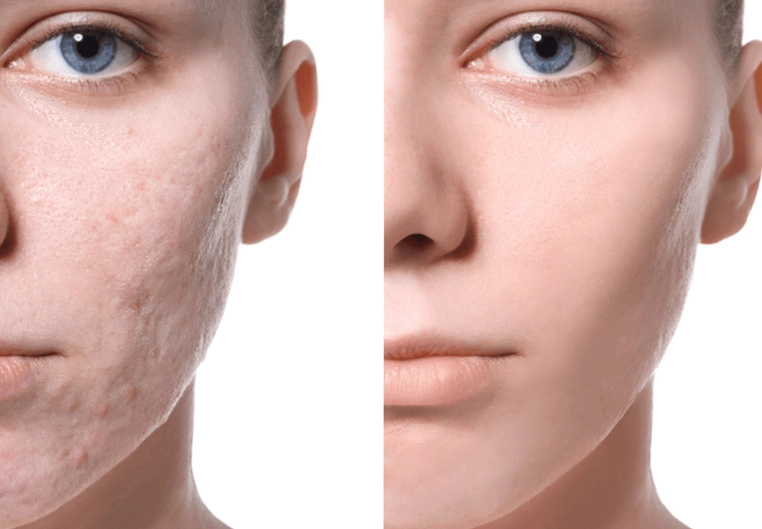 Halo Laser Treatment