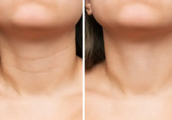 Skincare after treatment