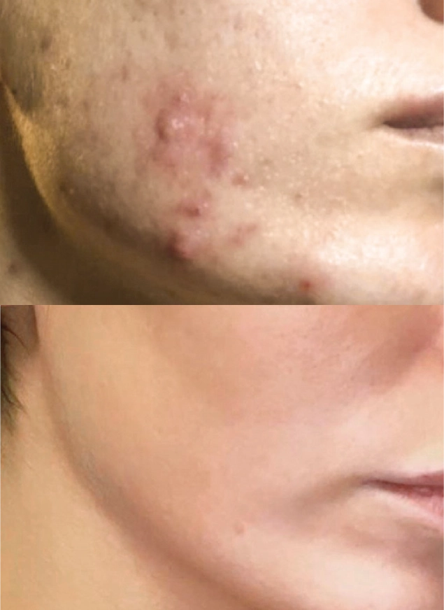 How Many BBL Acne Treatments Are Needed