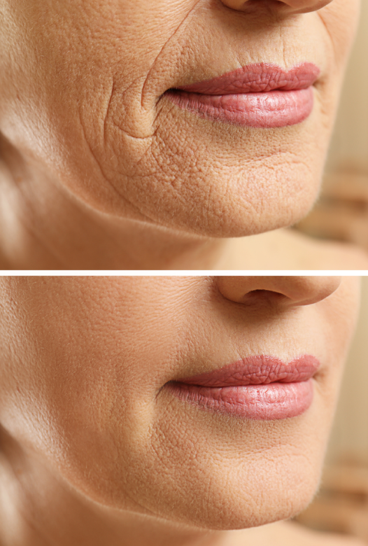 Illuminate Beauty with Halo Laser Therapy Daydreams Spa