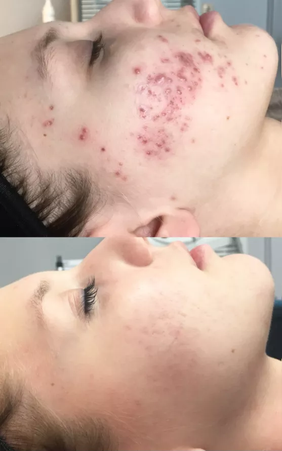 Recovery from BBL Laser Treatment Recovery from BBL Laser Treatment