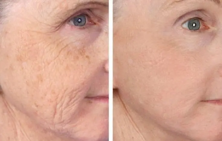 Who is a Good Candidate for This Treatment Who is a Good Candidate for This Treatment