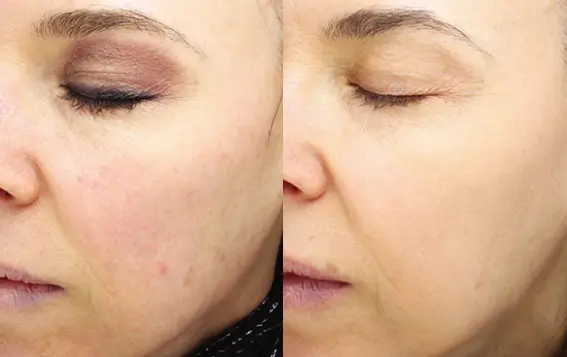 Halo Laser Therapy