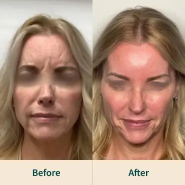 Dysport After-before Dysport After-before