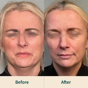 Dysport After-before Dysport After-before